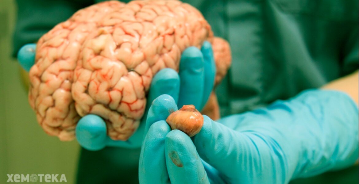 Опухоль головного мозга - лечение рака мозга - Хемотека