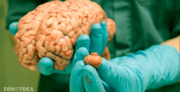 Пухлини головного мозку
